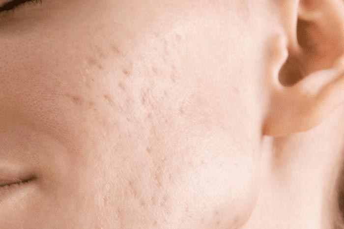 여드름 흉터 치료는 언제 시작해야 효과적일까?