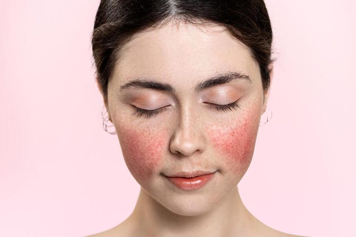 자가면역질환 홍반루푸스, 피부 증상으로 알아보는 초기 징후