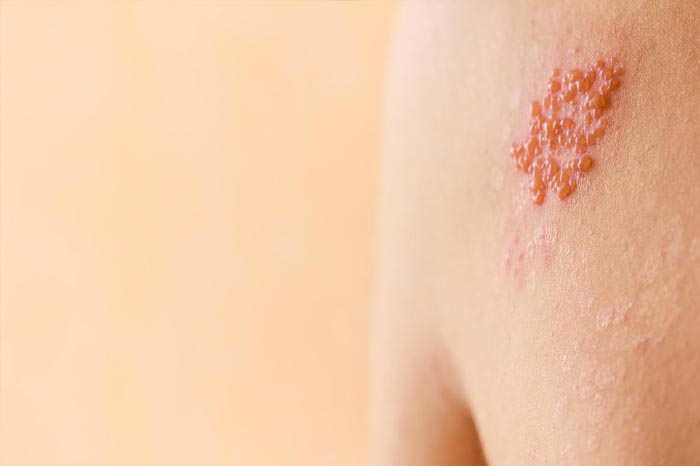 대상포진 초기증상과 예방접종의 중요성