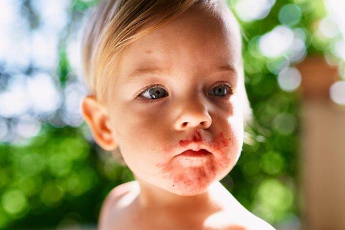 어린이에게 흔한 농가진, 전염 주의와 치료 포인트
