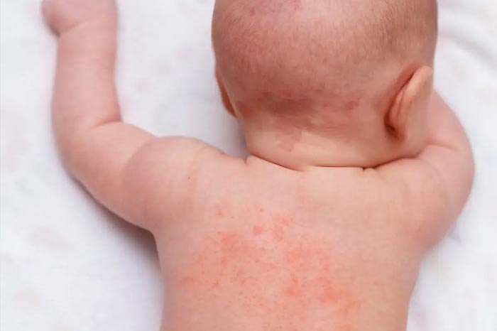 여름철 땀띠, 방치하면 안 되는 이유와 관리법